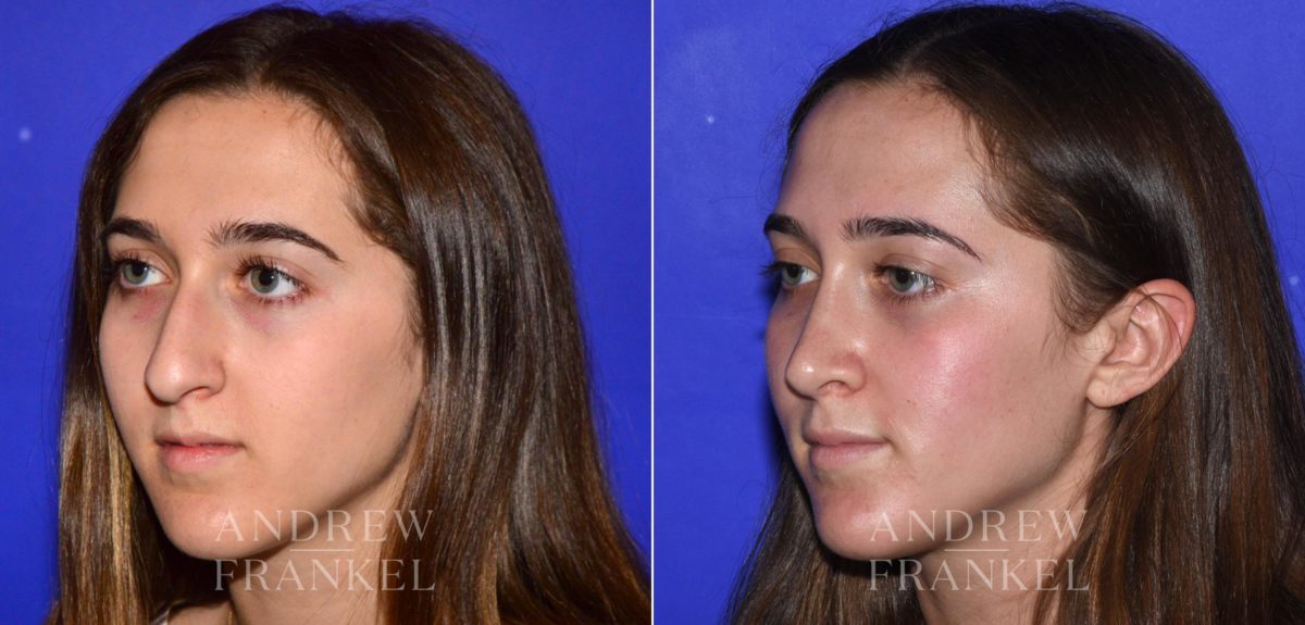 Rhinoplasty before and after photos in Beverly Hills, CA, Patient 15200
