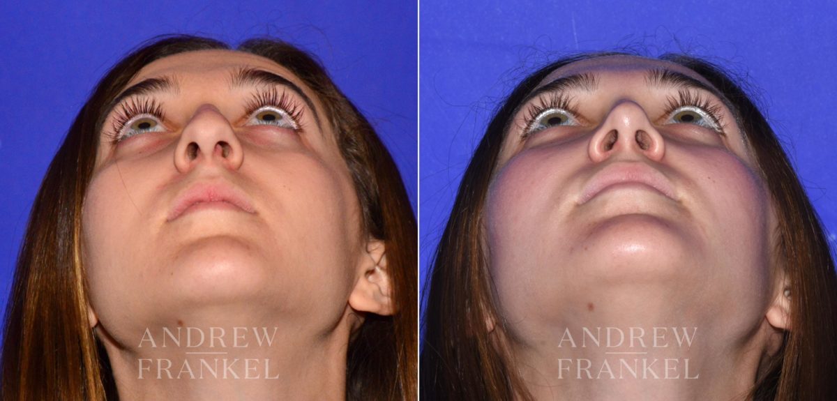 Rhinoplasty before and after photos in Beverly Hills, CA, Patient 15200