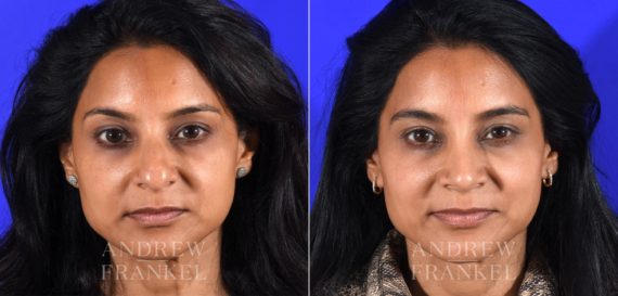 Rhinoplasty before and after photos in Beverly Hills, CA, Patient 16118