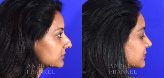 Rhinoplasty before and after photos in Beverly Hills, CA, Patient 16118