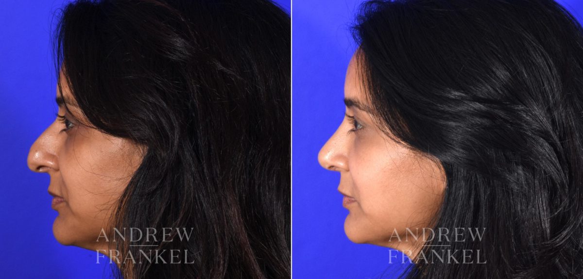 Rhinoplasty before and after photos in Beverly Hills, CA, Patient 16118