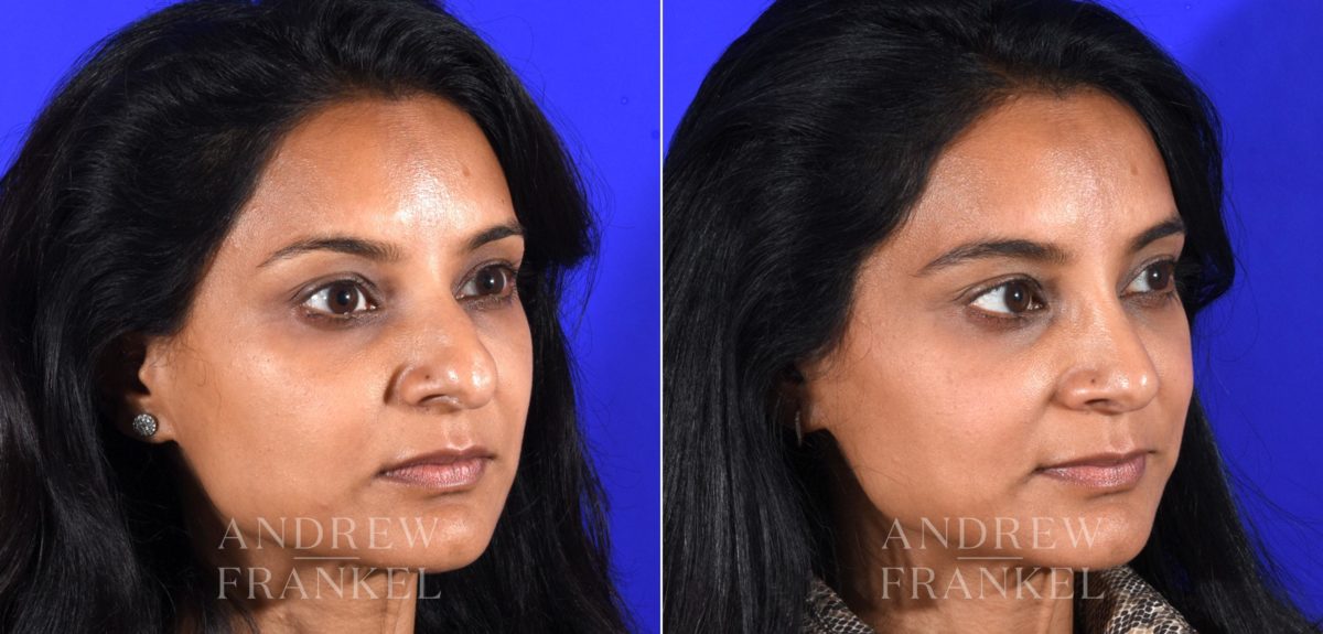 Rhinoplasty before and after photos in Beverly Hills, CA, Patient 16118