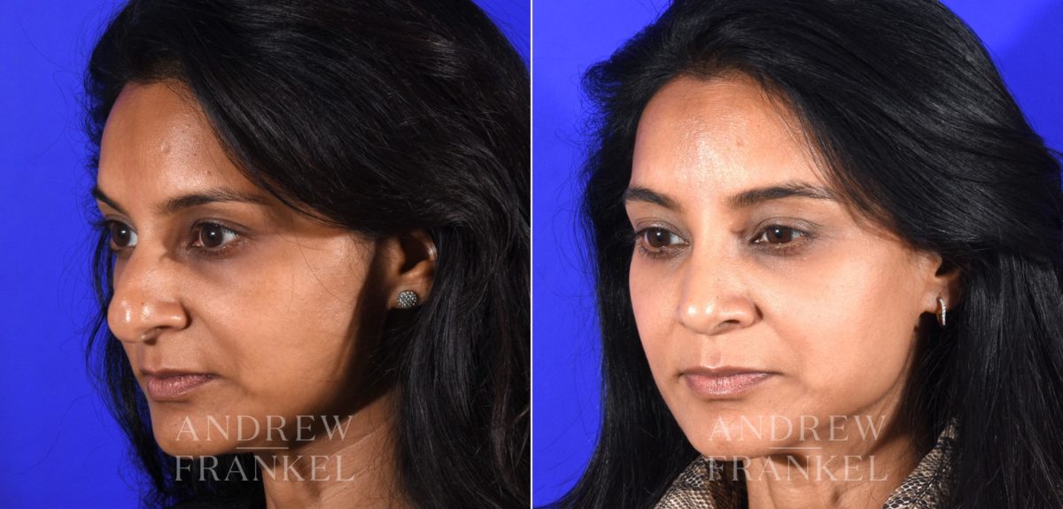 Rhinoplasty before and after photos in Beverly Hills, CA, Patient 16118
