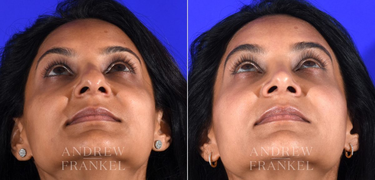Rhinoplasty before and after photos in Beverly Hills, CA, Patient 16118