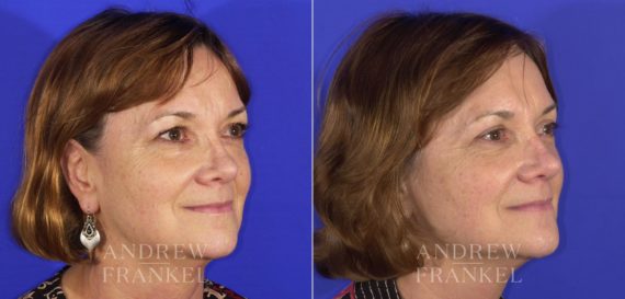 Blepharoplasty before and after photos in Beverly Hills, CA, Patient 3213