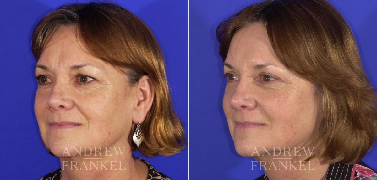 Blepharoplasty before and after photos in Beverly Hills, CA, Patient 3213
