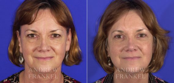 Blepharoplasty before and after photos in Beverly Hills, CA, Patient 3213