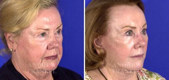 Blepharoplasty before and after photos in Beverly Hills, CA, Patient 3226