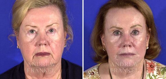 Blepharoplasty before and after photos in Beverly Hills, CA, Patient 3226