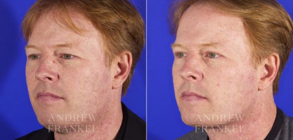 Blepharoplasty before and after photos in Beverly Hills, CA, Patient 3273