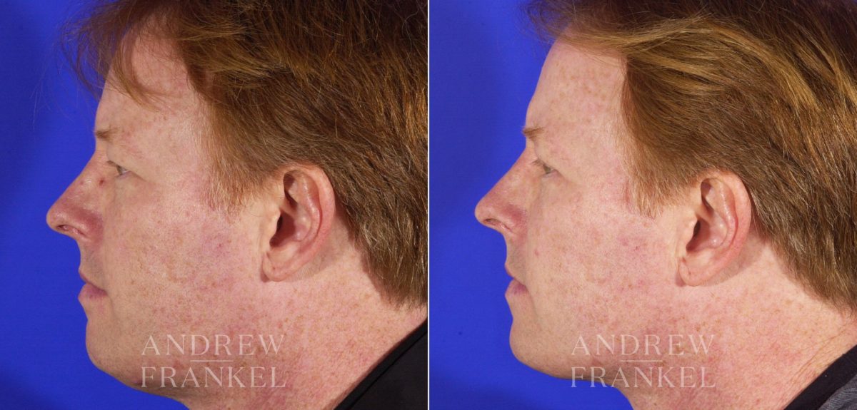 Blepharoplasty before and after photos in Beverly Hills, CA, Patient 3273