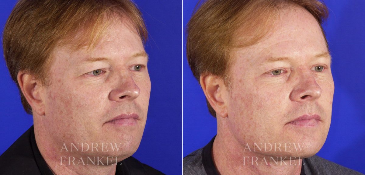 Blepharoplasty before and after photos in Beverly Hills, CA, Patient 3273