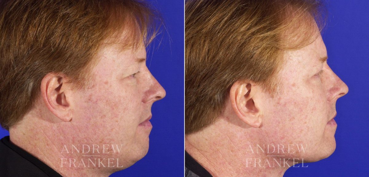 Blepharoplasty before and after photos in Beverly Hills, CA, Patient 3273
