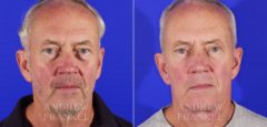 Blepharoplasty before and after photos in Beverly Hills, CA, Patient 3316
