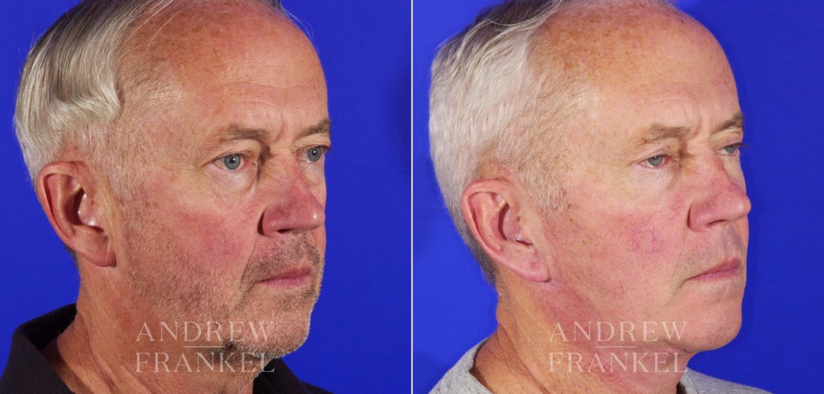 Blepharoplasty before and after photos in Beverly Hills, CA, Patient 3316