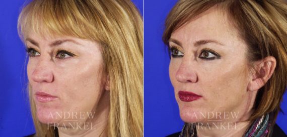 Blepharoplasty before and after photos in Beverly Hills, CA, Patient 3325