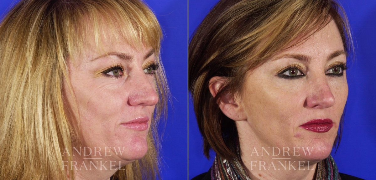 Blepharoplasty before and after photos in Beverly Hills, CA, Patient 3325
