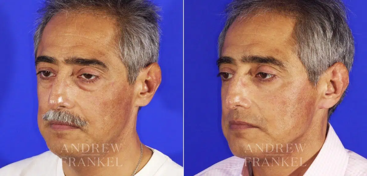 Blepharoplasty before and after photos in Beverly Hills, CA, Patient 3338