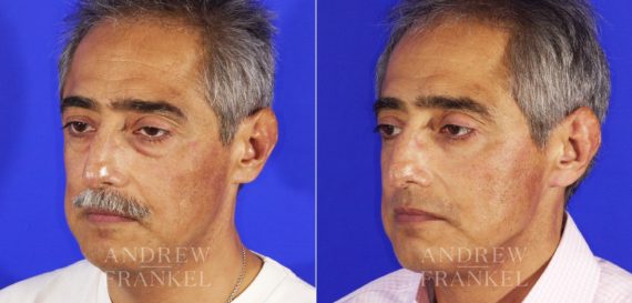 Blepharoplasty before and after photos in Beverly Hills, CA, Patient 3338