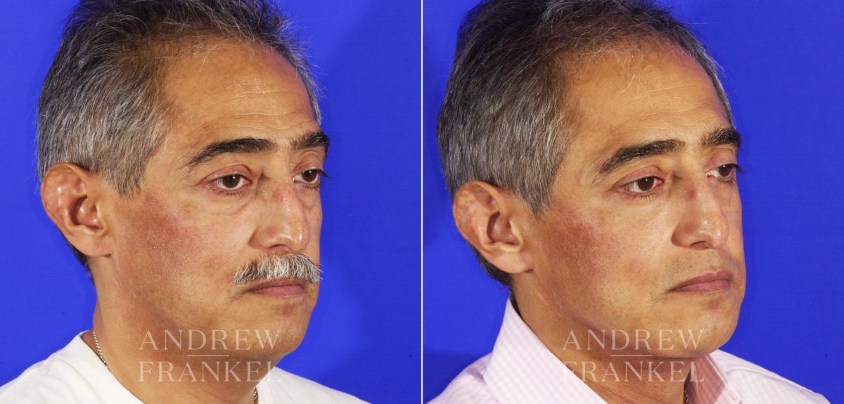 Blepharoplasty before and after photos in Beverly Hills, CA, Patient 3338