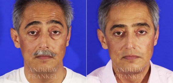 Blepharoplasty before and after photos in Beverly Hills, CA, Patient 3338