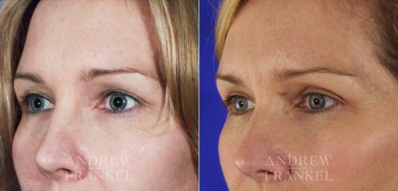 Blepharoplasty before and after photos in Beverly Hills, CA, Patient 3351