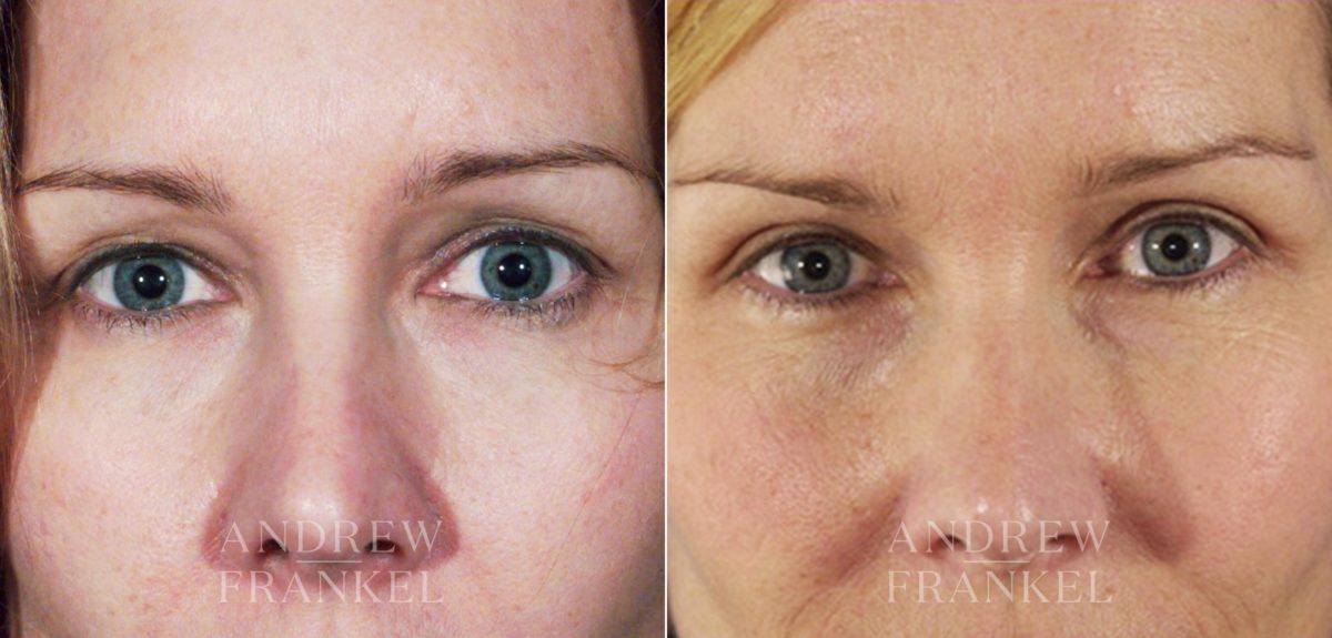 Blepharoplasty before and after photos in Beverly Hills, CA, Patient 3351