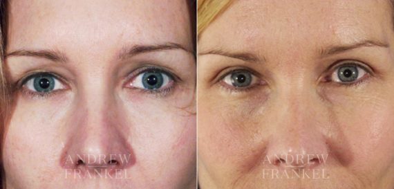 Blepharoplasty before and after photos in Beverly Hills, CA, Patient 3351