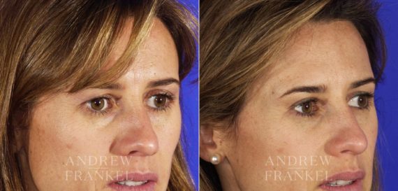 Blepharoplasty before and after photos in Beverly Hills, CA, Patient 3377