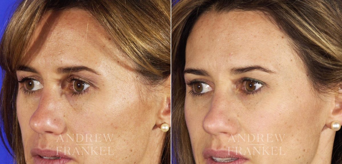 Blepharoplasty before and after photos in Beverly Hills, CA, Patient 3377