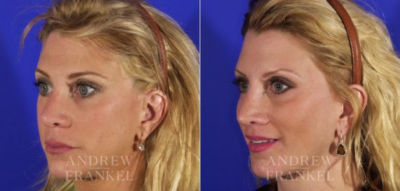 Brow Lift before and after photos in Beverly Hills, CA, Patient 3411