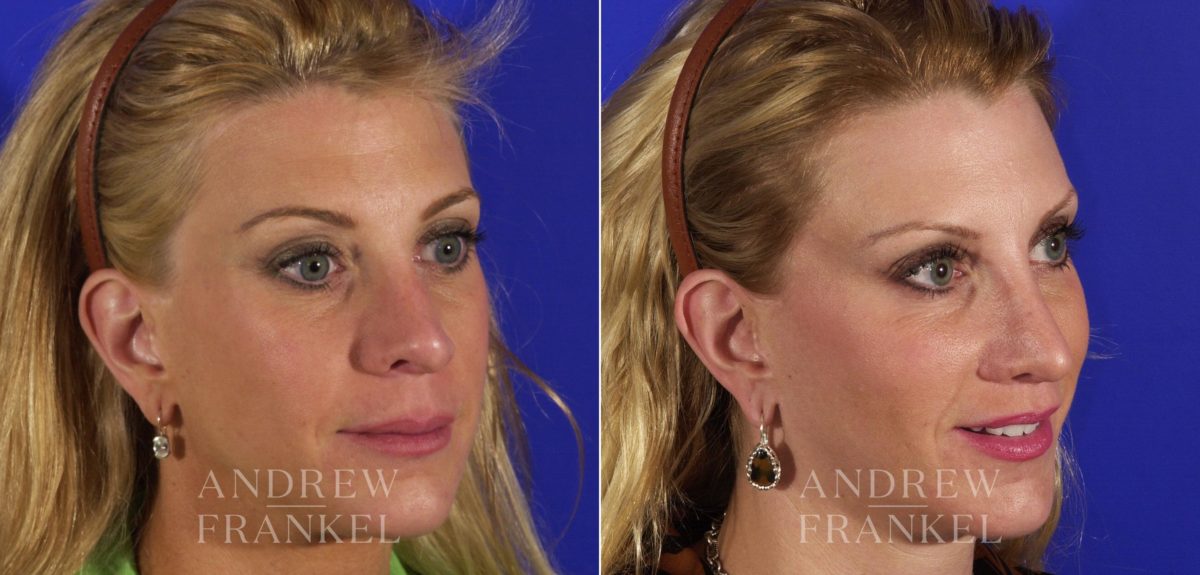 Brow Lift before and after photos in Beverly Hills, CA, Patient 3411