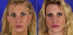 Brow Lift before and after photos in Beverly Hills, CA, Patient 3411