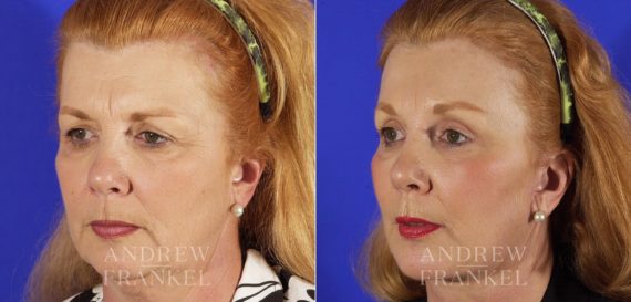 Brow Lift before and after photos in Beverly Hills, CA, Patient 3425