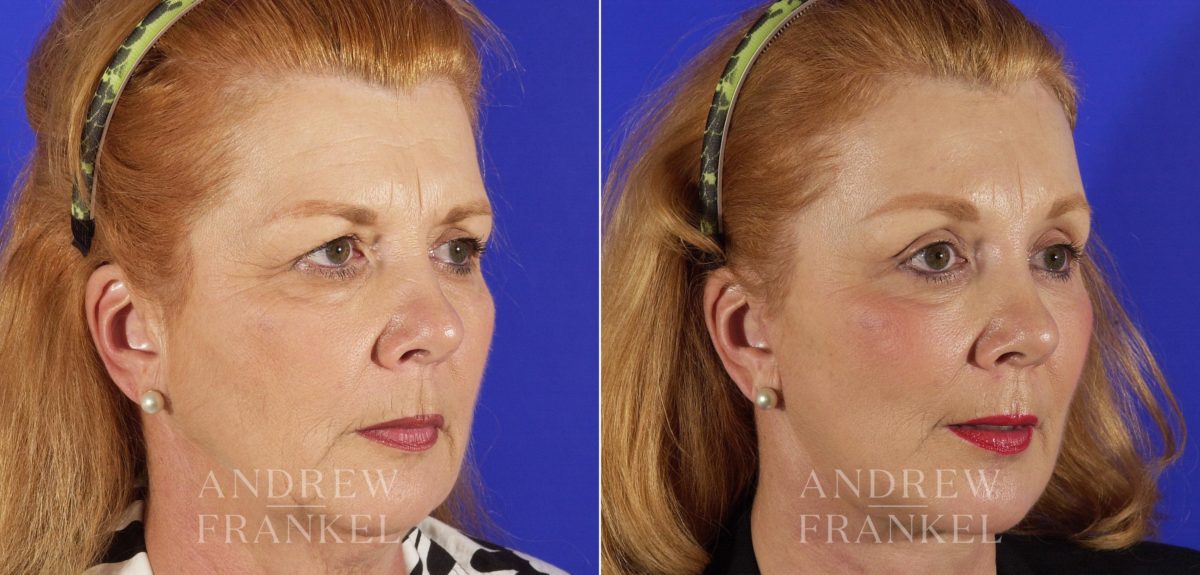 Brow Lift before and after photos in Beverly Hills, CA, Patient 3425