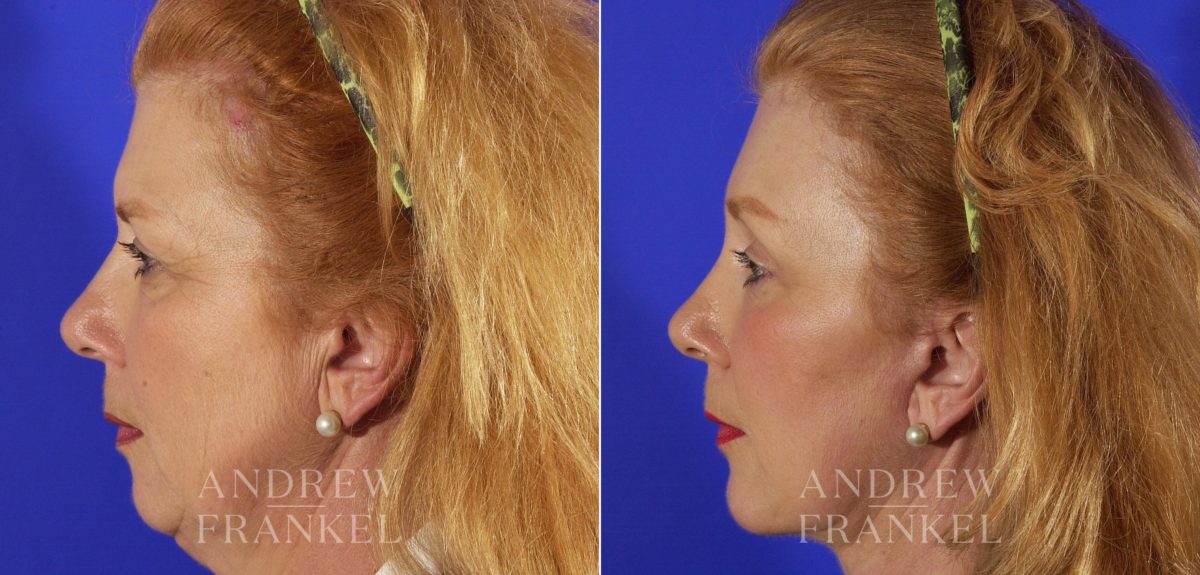 Brow Lift before and after photos in Beverly Hills, CA, Patient 3425