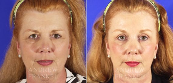 Brow Lift before and after photos in Beverly Hills, CA, Patient 3425