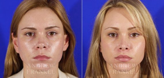 Brow Lift before and after photos in Beverly Hills, CA, Patient 3451