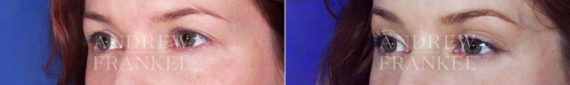 Brow Lift before and after photos in Beverly Hills, CA, Patient 3499