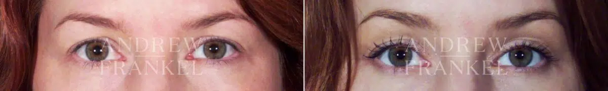 Brow Lift before and after photos in Beverly Hills, CA, Patient 3499