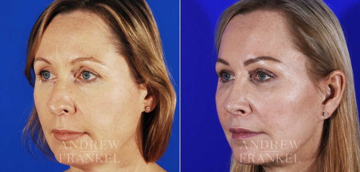 Brow Lift before and after photos in Beverly Hills, CA, Patient 3512