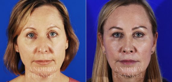 Brow Lift before and after photos in Beverly Hills, CA, Patient 3512