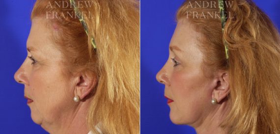 Jawline Contouring before and after photos in Beverly Hills, CA, Patient 3546