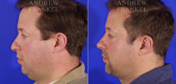 Jawline Contouring before and after photos in Beverly Hills, CA, Patient 3601