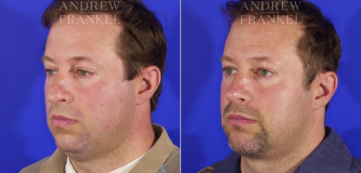 Jawline Contouring before and after photos in Beverly Hills, CA, Patient 3601