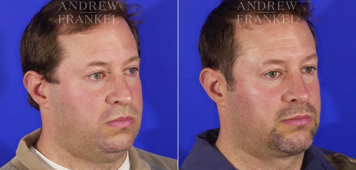 Jawline Contouring before and after photos in Beverly Hills, CA, Patient 3601