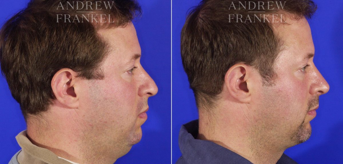 Jawline Contouring before and after photos in Beverly Hills, CA, Patient 3601