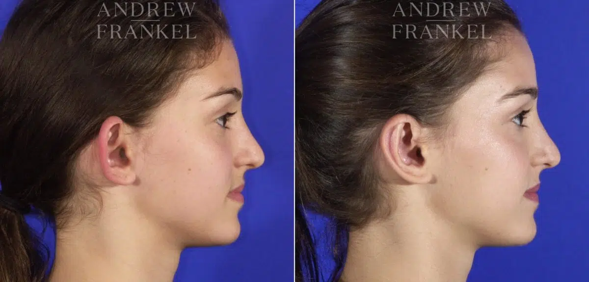 Otoplasty before and after photos in Beverly Hills, CA, Patient 3622