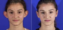 Otoplasty before and after photos in Beverly Hills, CA, Patient 3622