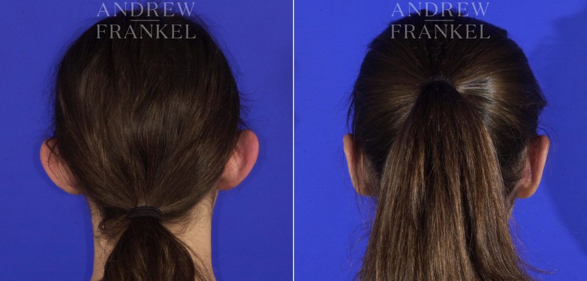 Otoplasty before and after photos in Beverly Hills, CA, Patient 3622